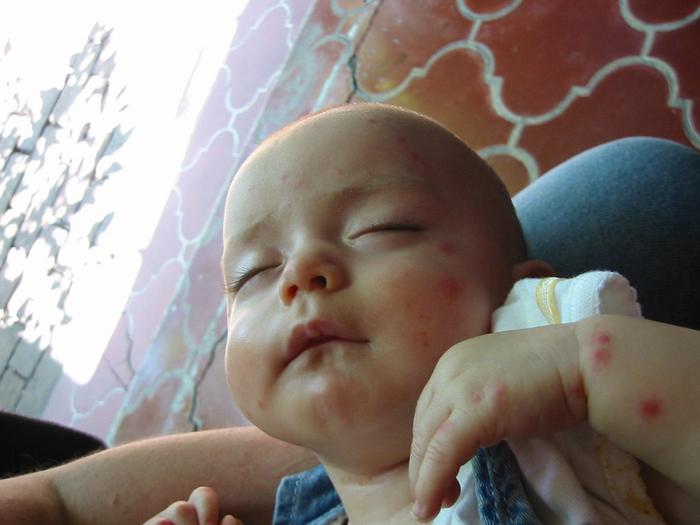 Chikungunya infections in children