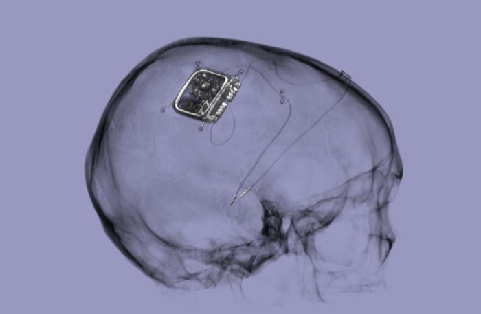 Picostim neurostimulator