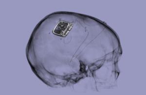 Picostim neurostimulator