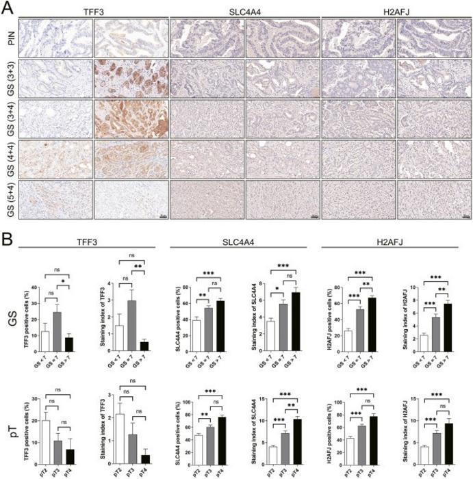 The expression levels of H2AFJ, SLC4A4, and TFF3 proteins in prostate tissues with PIN and varying GSs.