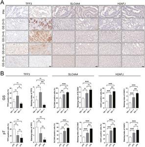 The expression levels of H2AFJ, SLC4A4, and TFF3 proteins in prostate tissues with PIN and varying GSs.
