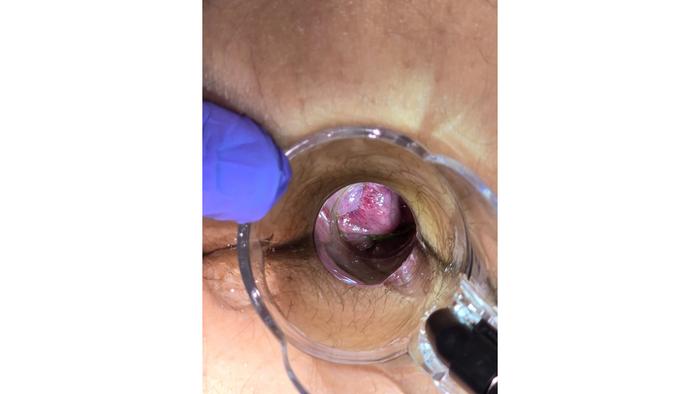 Diagnosis and treatment of hemorrhoids