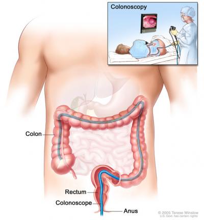 Colonoscopy