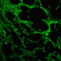 Factors Increase Blood Supply to Breast Tumors