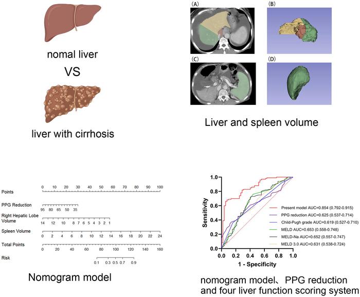 Hepatosplenic Volumes and Portal Pressure Gradient Identify One-year Further Decompensation Risk Post-transjugular Intrahepatic Portosystemic Shunt