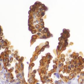 Ovarian Cancer Clumps