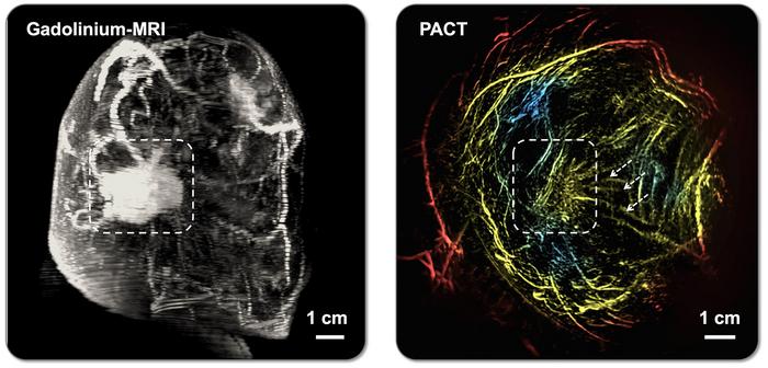 AI-Assisted Technique Offers Safe, Effective, Painless Breast Imaging Alternative