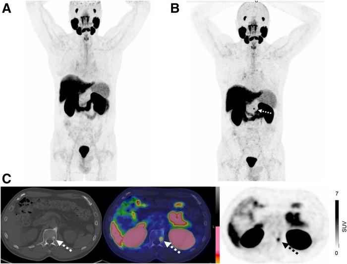 The utility of PSMA PET/CT after an initial negative scan: PSMA PET Registry