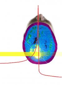 Ion Beam Therapy