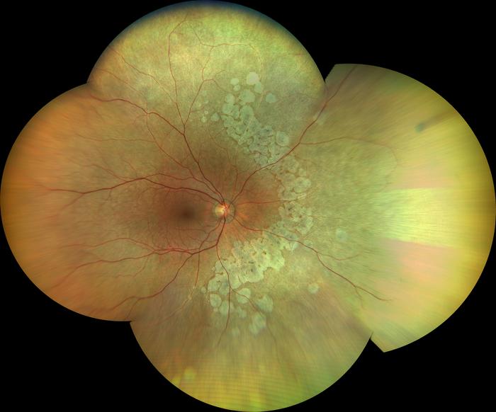 New Hereditary Retinal Disease Discovered