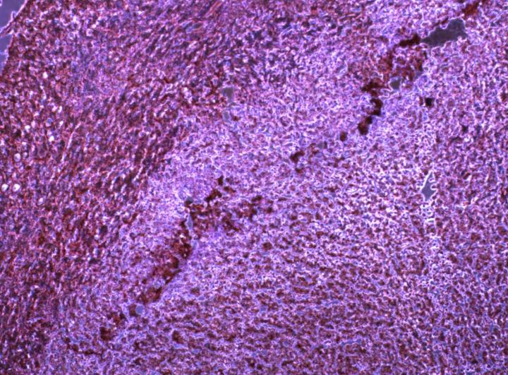 MicroRNA Helps Cancer Evade Immune System