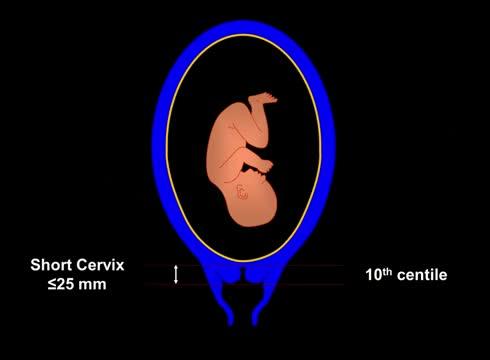 Vaginal Progesterone Reduces Preterm Birth and Neonatal Complications in Women with a Mid-trimester 