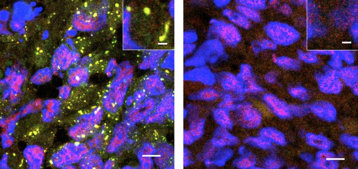 Stress Granules in Tumors
