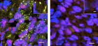 Stress Granules in Tumors