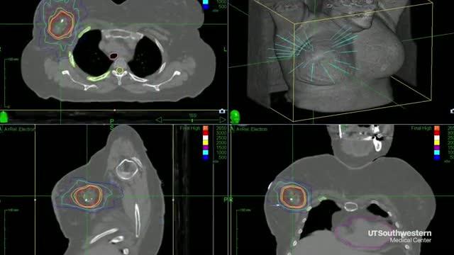Advancing Breast Cancer Care