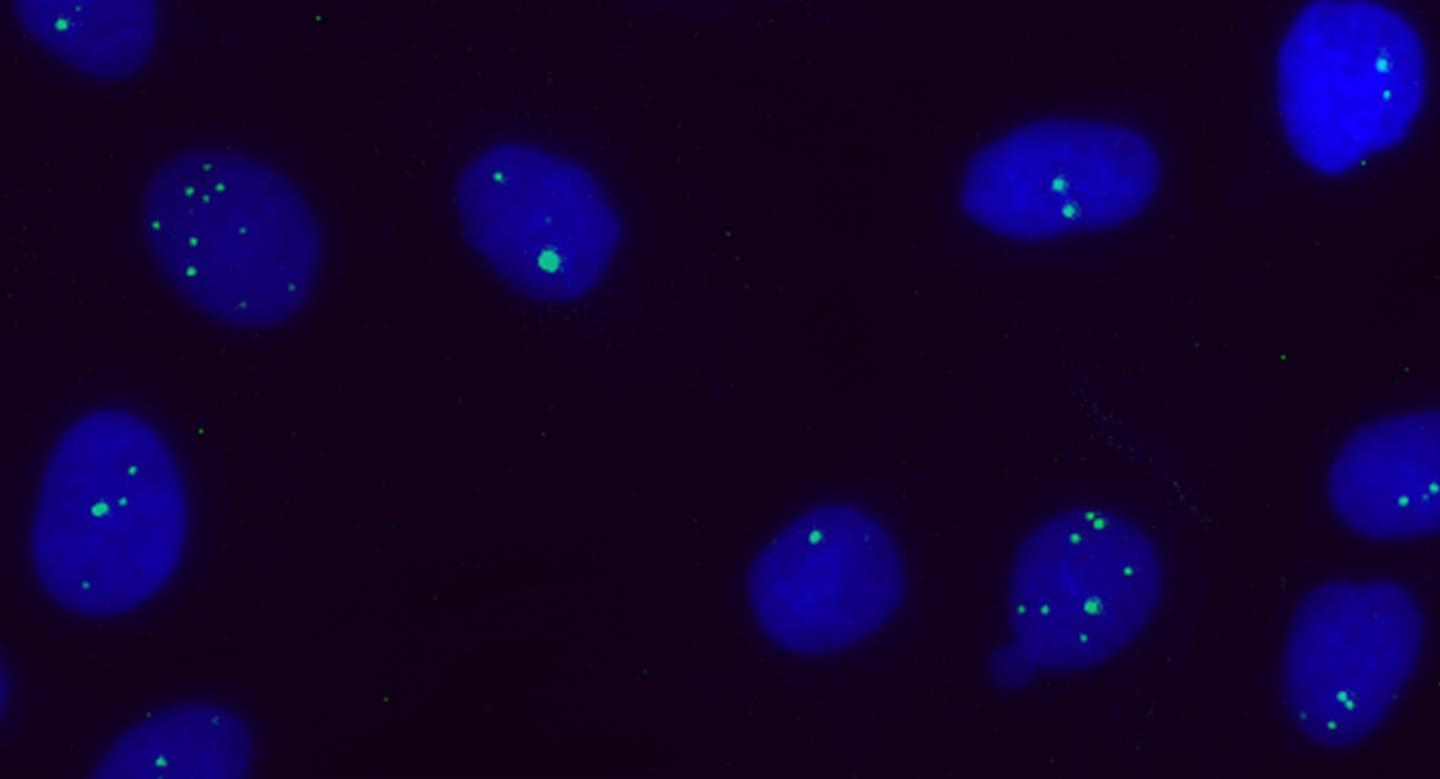 A Promising Target to Treat Myotonic Dystrophy Type 1 (2 of 3)