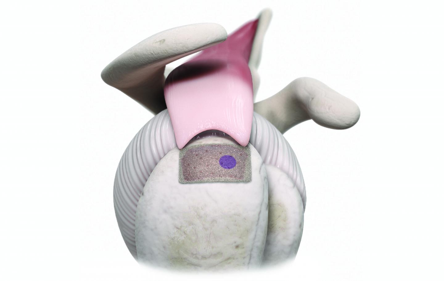 Rotator cuff implant