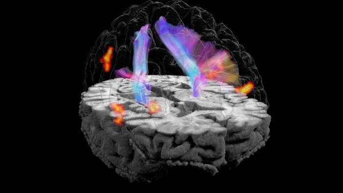 3D view of the brain