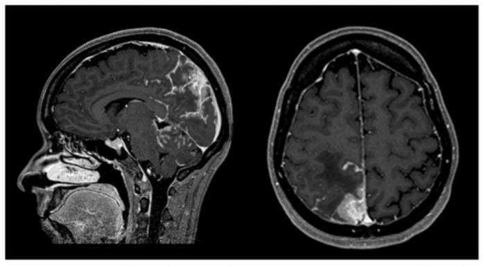 Metastatic breast cancer with leptomeningeal carcinomatosis treated with trastuzumab deruxtecan – a case report