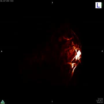 Photoacoustic Imaging of a Hypoxic Tumor