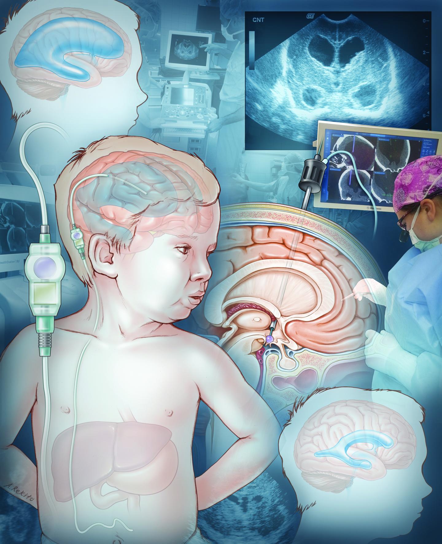 Pediatric Hydrocephalus
