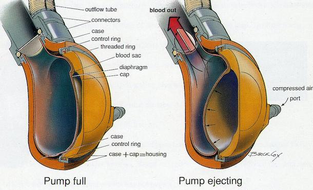 Heart Pump