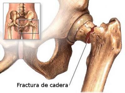 Hip Fracture