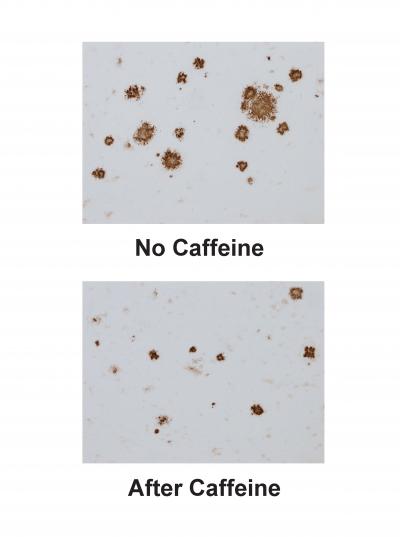 Alzheimer's Plaques