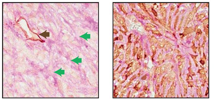 Tumor Cells Can Mimic Blood Vessels, Helping Cancer Spread