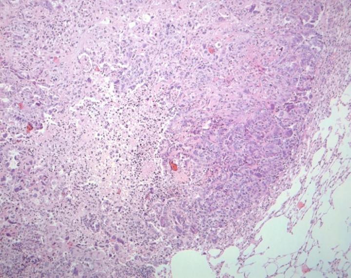 Lung Cancer