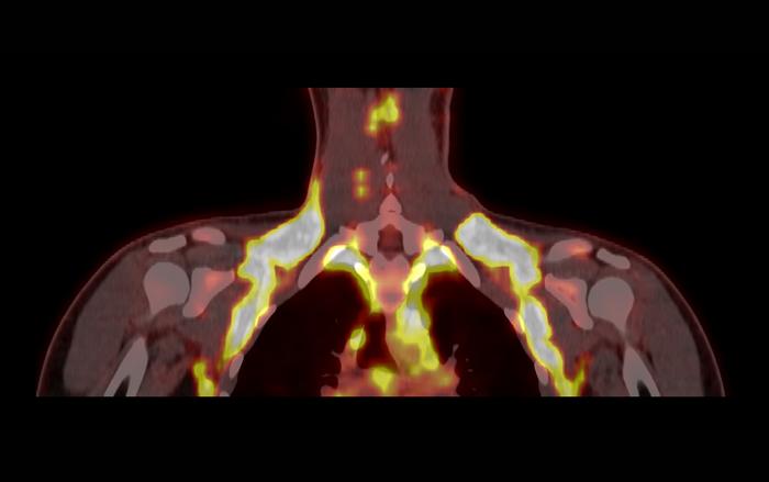 Cold-activated brown adipose tissue