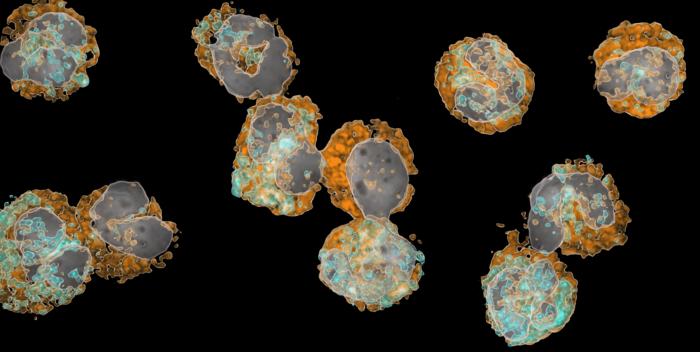 Neutrophil Granulocytes at Various Stages of Maturation in the Blood of a Patient Who Has Had a Severe Heart Attack