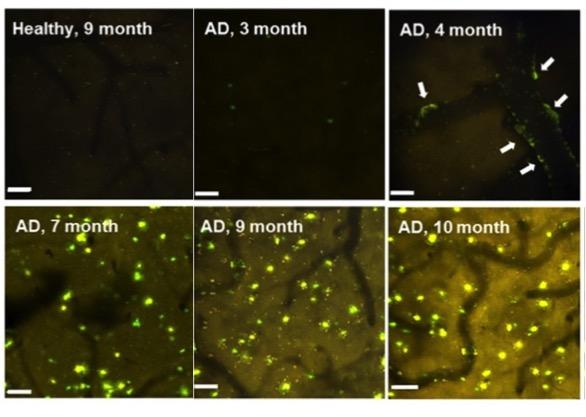 Enzyme Could Be Alzheimer's Disease Biomarker