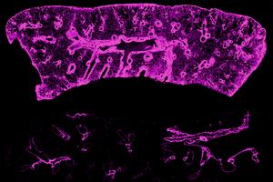 Surprising culprit leads to chronic rejection of transplanted lungs, hearts