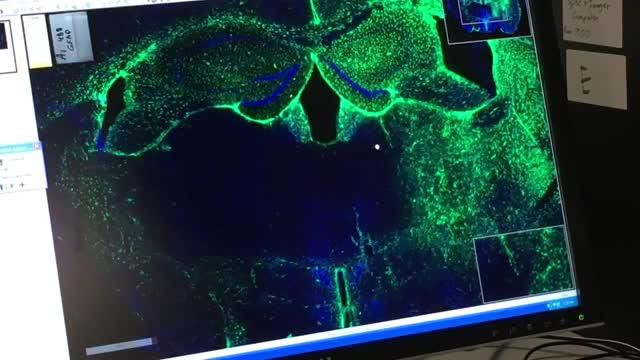 SBP's Dr. Aman Mann on Alzheimer's Discovery