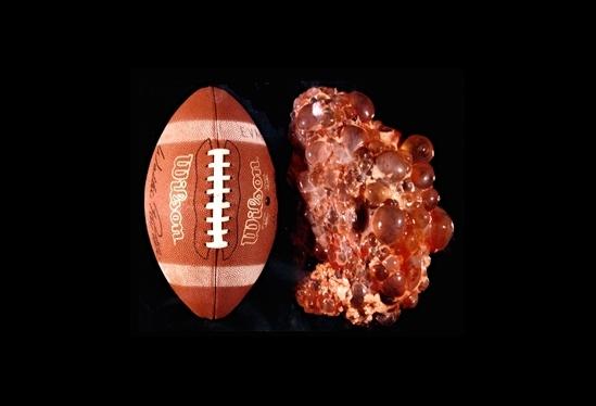 A Human Polycystic Kidney