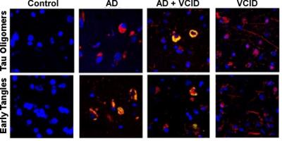Cis P-tau accumulates in dementia-damaged neurons.