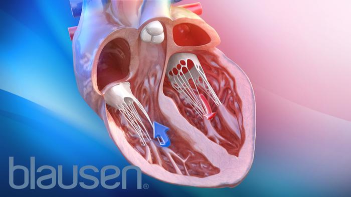 A digital rendering of a heart with HFpEF