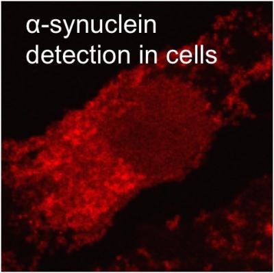 Fibrallar Deposits Associated with Parkinson's Disease