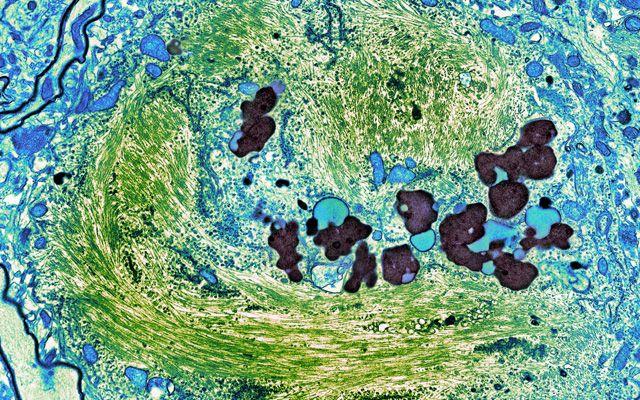 Tau in a Brain Cell