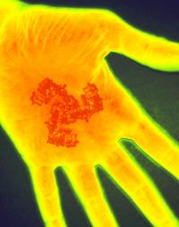 A Gene for Painful Touch