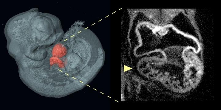 Risk Factors for Congenital Heart Defects May Lie Both Inside and Outside the Heart