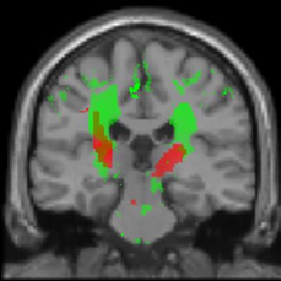 Tissue Loss Seen within 40 Days of Spinal Cord Injury