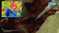 Removing Microscopic Tumors with Cold Plasma