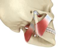 Rassi Implant Illustration