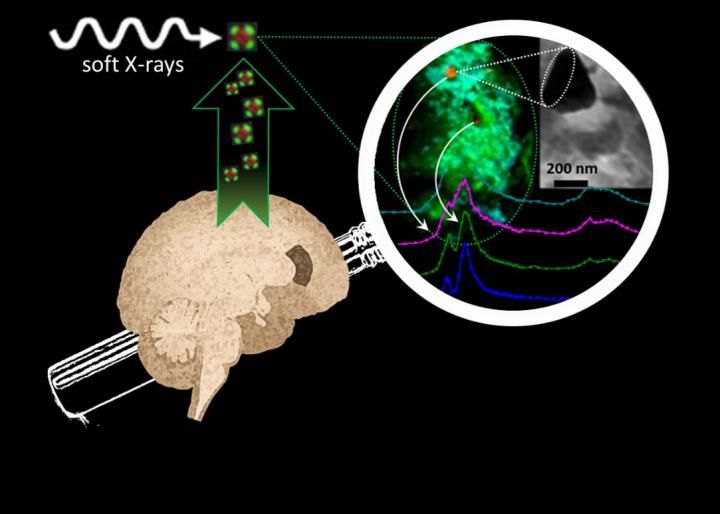 Alzheimer's Breakthrough: Brain Metals That May Drive Disease Progression Revealed
