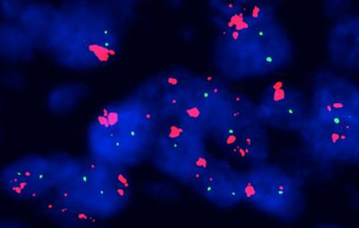 Squashing Cancer in Smoker's Lungs (1 of 3)