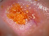 Chigger Aggregation