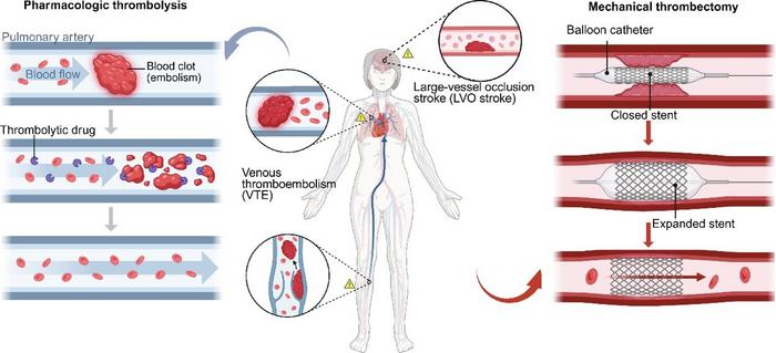 Pharmacological thrombolysis and tethered endovascular interventions.