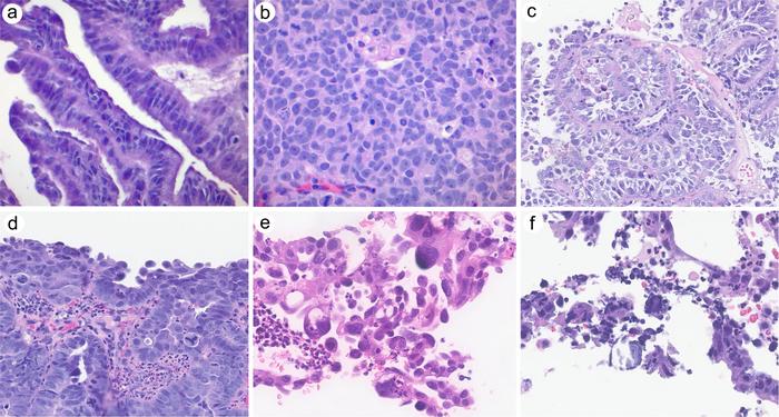 Variable morphologic features of high-grade serous carcinoma involving the cervix